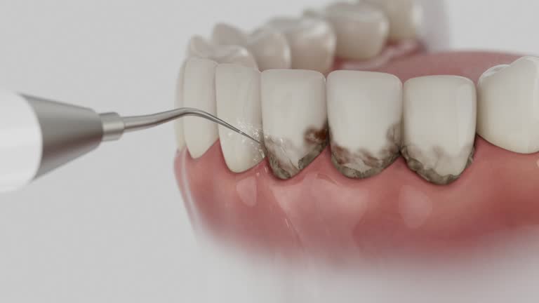 Trusted Wisdom Tooth Removal service in Newburgh Heights, OH - Dentist Open Now